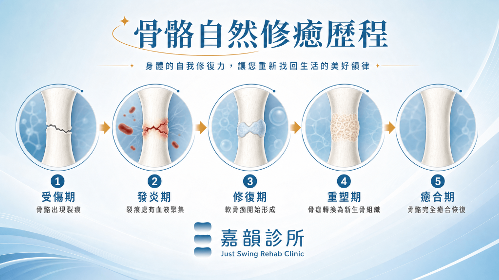 骨骼自然修復歷程示意圖:受傷期、發炎期、修復期、重塑期、癒合期五個階段