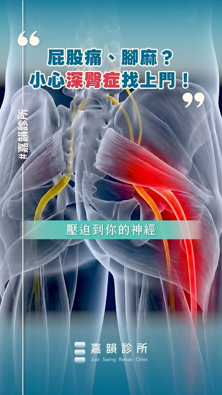 屁股痛、腳麻，小心深臀症找上門